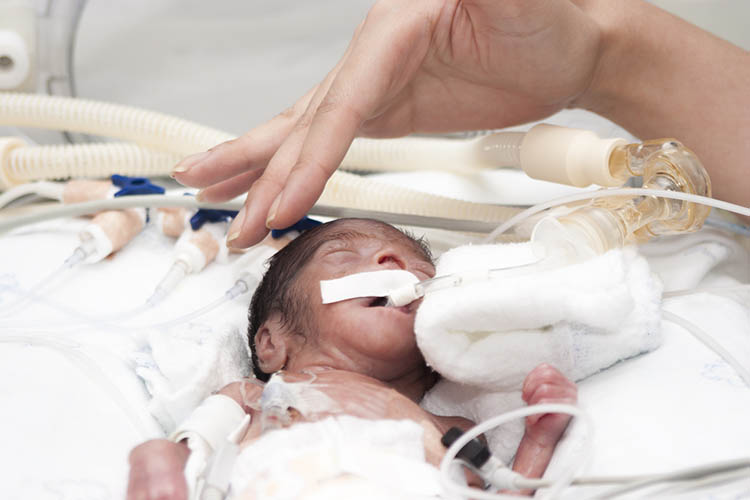 Unplanned Extubations In The Nicu Daily Nurse